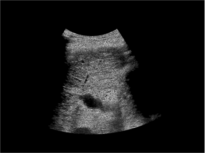Ultrasound Imaging Denoising AI